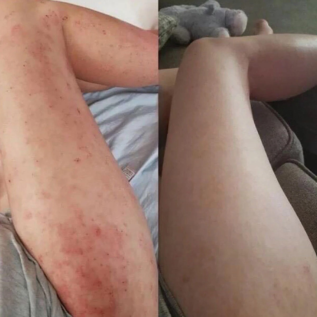 Healed My Eczema – Soothing Cream for Calming & Restoring Irritated Skin - ElevateHealthTech