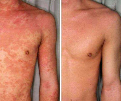 Healed My Eczema – Soothing Cream for Calming & Restoring Irritated Skin - ElevateHealthTech
