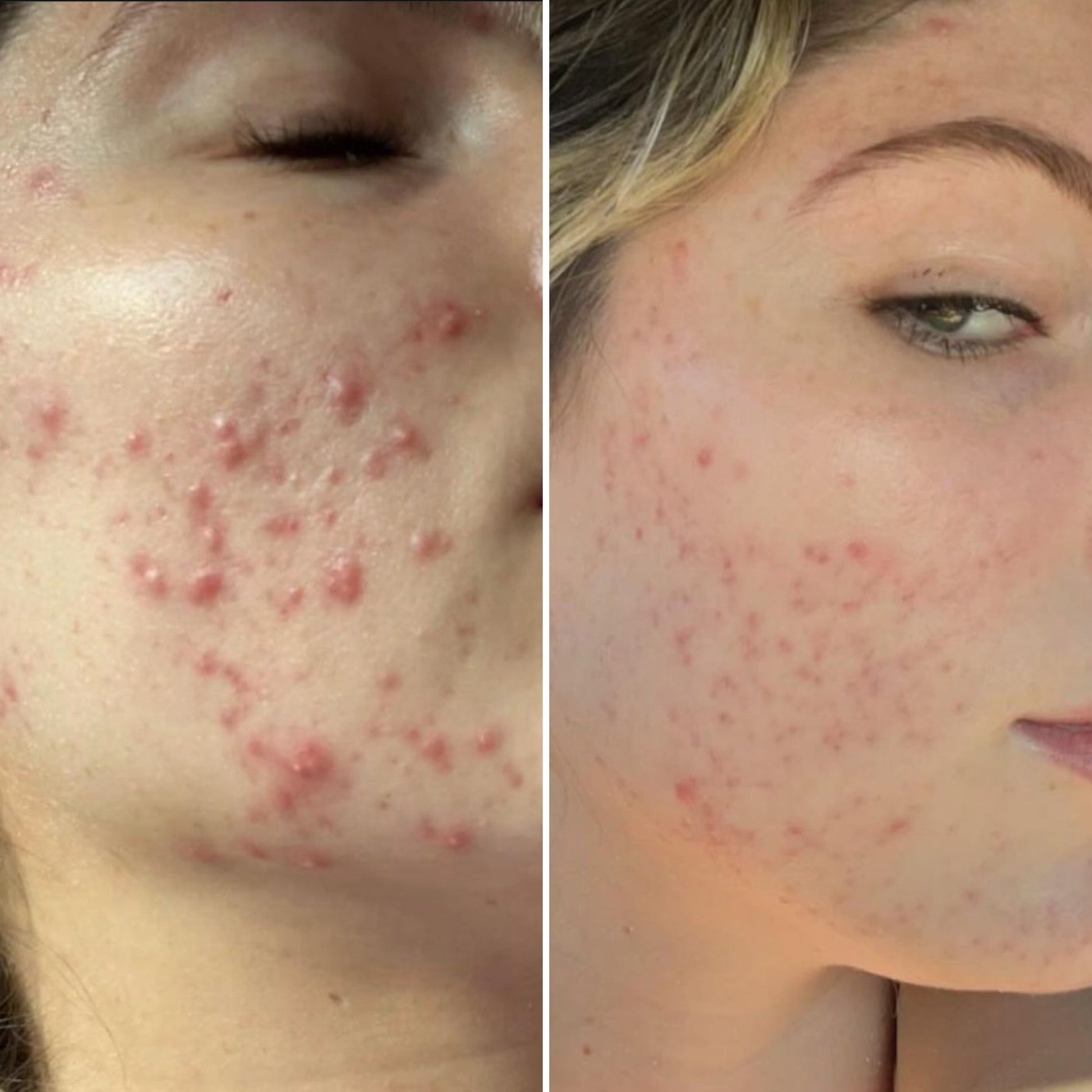 Mandelic Acid Serum 5% – Gentle Daily Exfoliating Serum for Sensitive & Blemish-Prone Skin - ElevateHealthTech