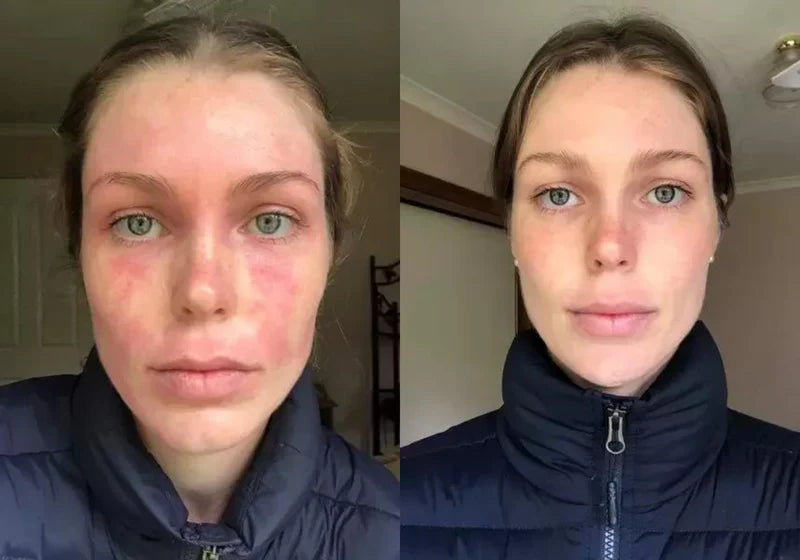 Healed My Eczema – Soothing Cream for Calming & Restoring Irritated Skin - ElevateHealthTech