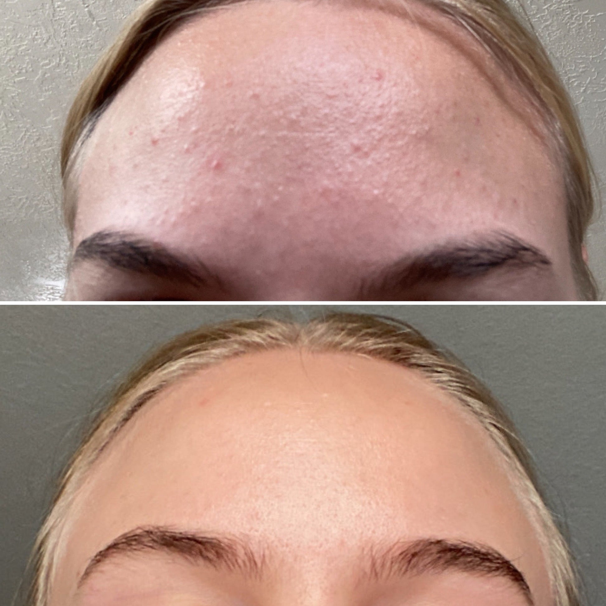 Mandelic Acid Serum 5% – Gentle Daily Exfoliating Serum for Sensitive & Blemish-Prone Skin - ElevateHealthTech